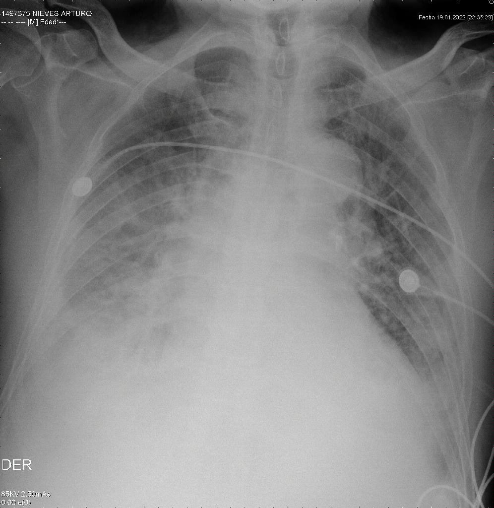 Radiografía de tórax de ingreso 13/01/2023